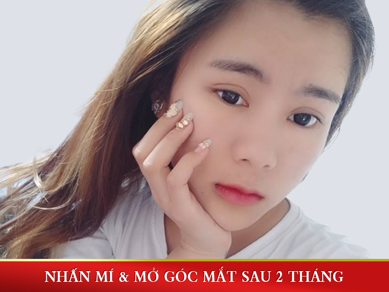 Hình ảnh nhấn mí và mở rộng góc mắt sau 2 tháng